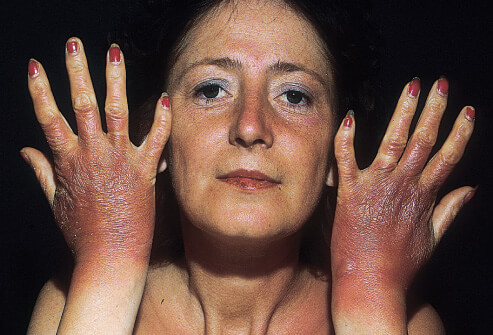 Picture of a phototoxic drug induced photosensitivity