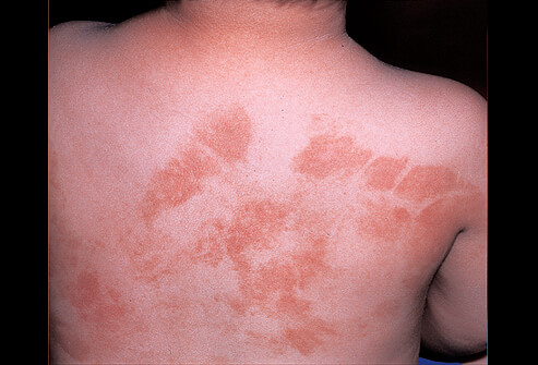 Picture of photodermatitis