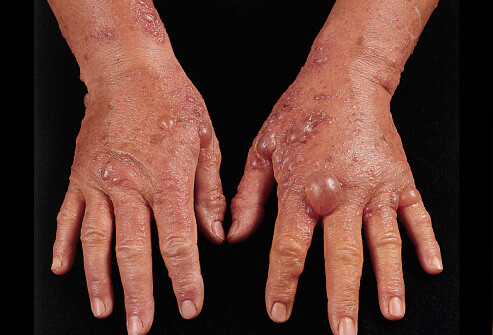 Picture of photodermatitis with blisters