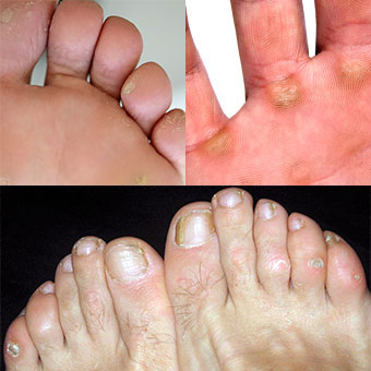 Examples of corns and calluses on the feet and hand.