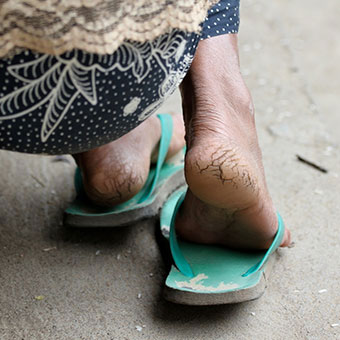 A woman has dry, hardened skin on her heels.