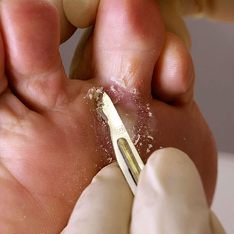 A podiatrist uses a scalpel to remove hardened skin from the foot of a patient.