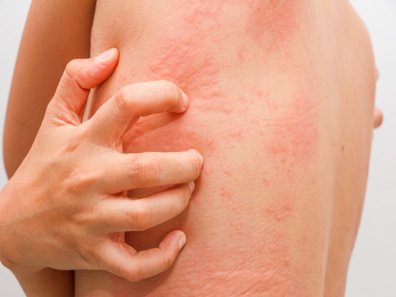 News Picture: Ditch the Itch: Researchers Find New Drug to Fight Hives
