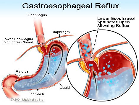 Picture of GERD (gastroesophageal reflux disease, heartburn)