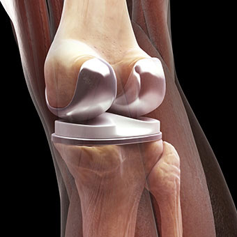 Total knee replacements require surgery to implant artificial knee joints.
