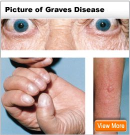 Picture of Graves' Disease Symptoms