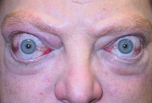 Picture of Graves' Disease