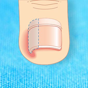 Ingrown toenail surgery involves temporary resection and removal of the nail border.
