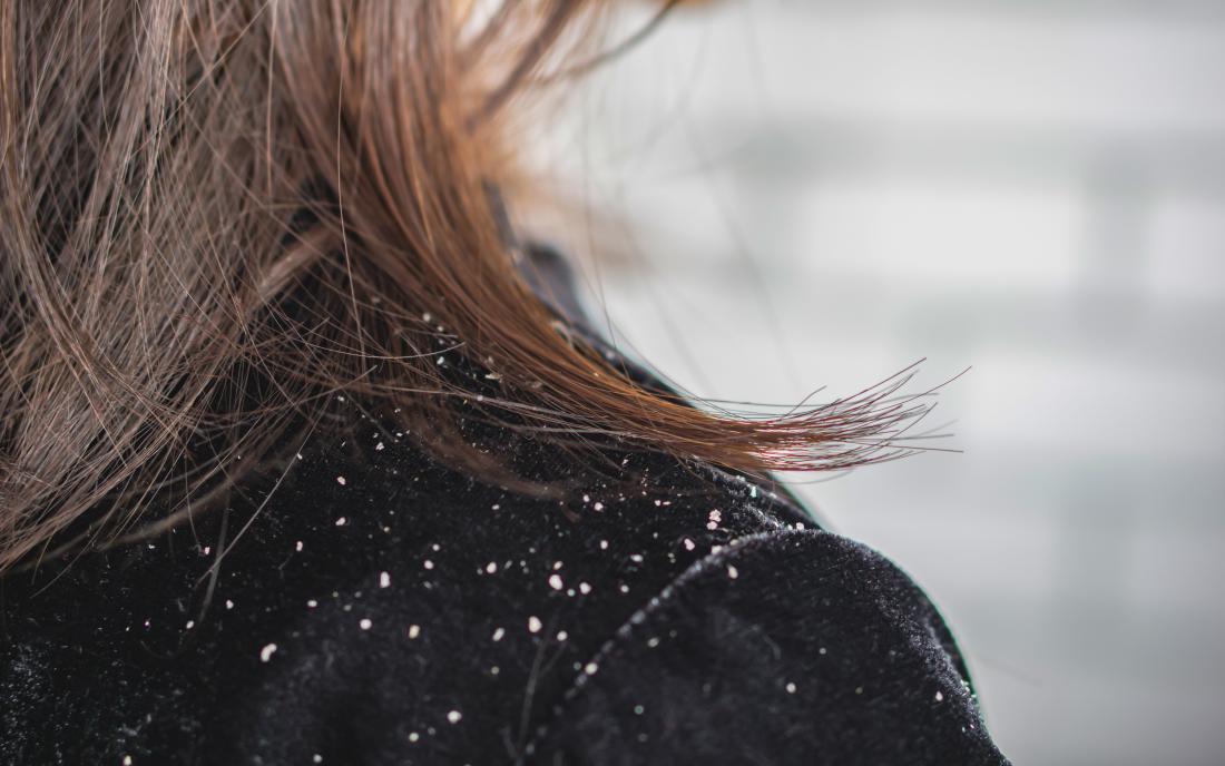 a woman with dandruff that may but not hair loss. 