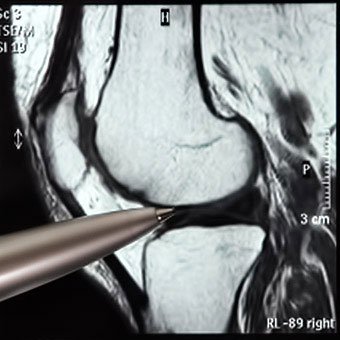 A medical image of where the knee bursae are located around the knee joint.