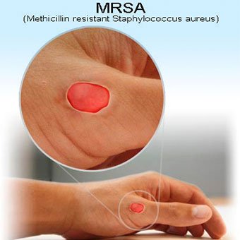An illustration shows a lesion caused by a methicillin-resistant Staphylococcus aureus (MRSA) bacterial infection.