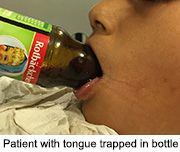 News Picture: Simple Fix Freed This Boy's Tongue Trapped in Bottle
