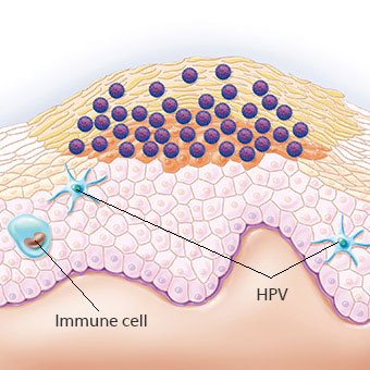 Illustration of a genital wart. The human papillomavirus (HPV) is visible near the wart and which is responsible for the wart. The blue cells represent the immune cells.