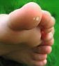 There are over 100 types of human papillomaviruses; some cause venereal warts, while others cause common skin warts.