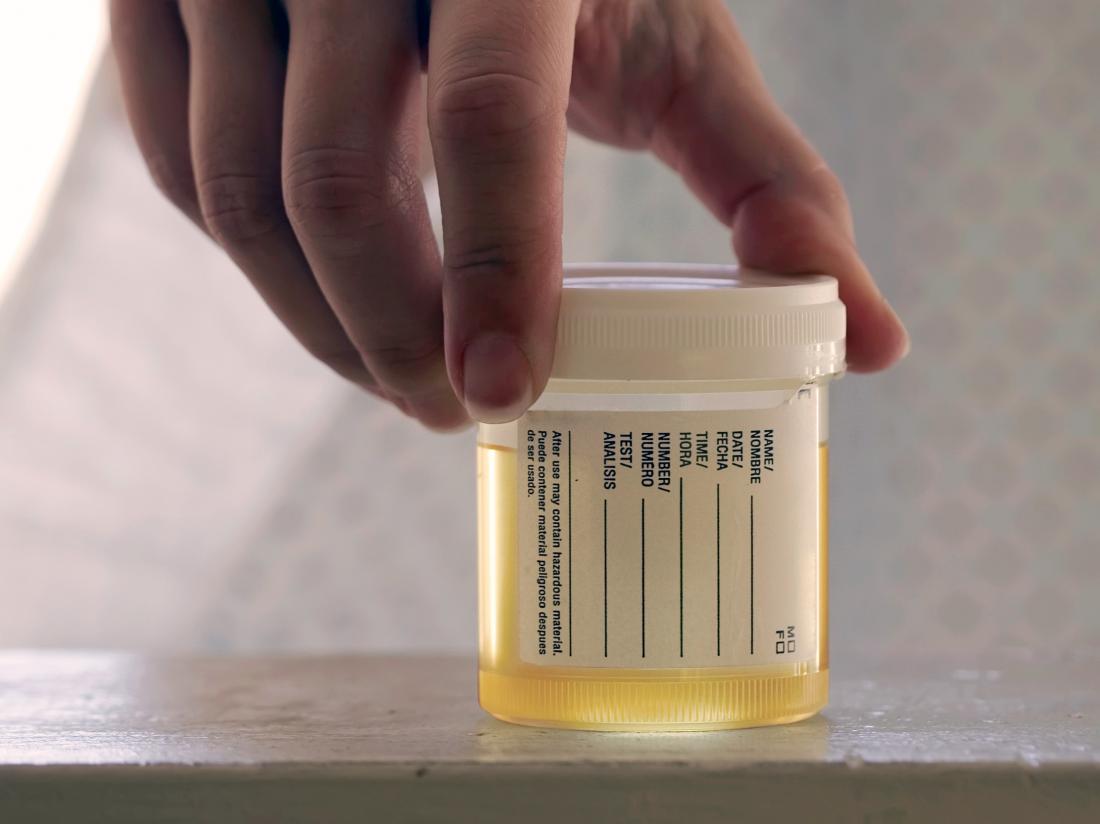 a urine sample that may have RBC in it. 