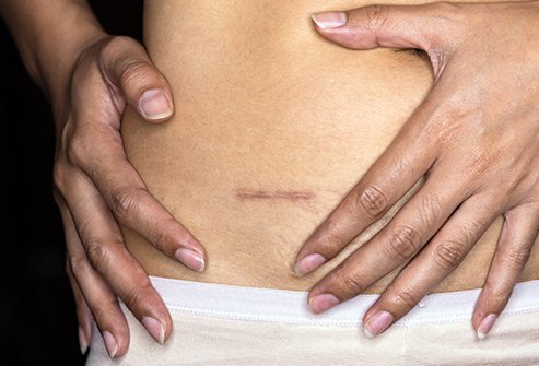  Picture of an abdominal scar after surgery 