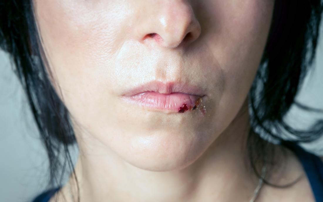 a woman with a split lip. 