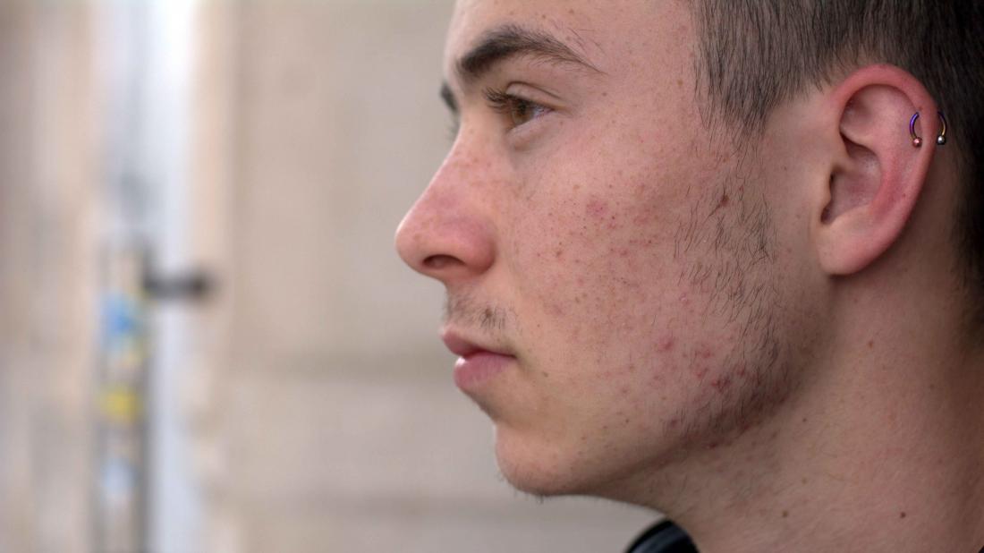 a side profile of a man who is wondering does masturbation cause his acne
