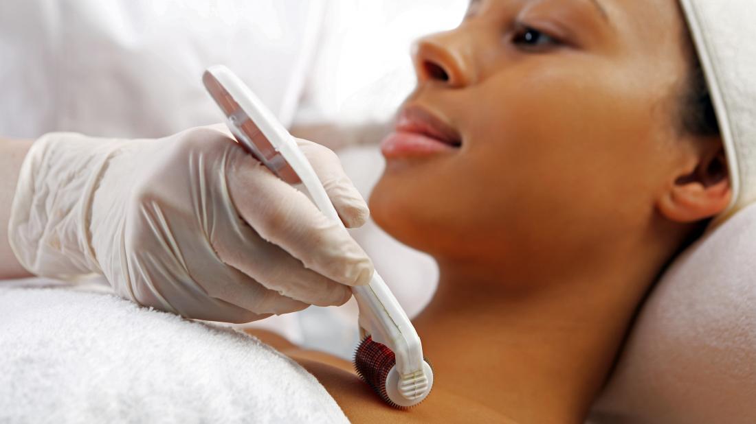 a woman receiving a Microneedling treatment with PRP