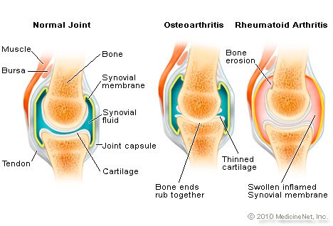 Picture of Rheumatoid Arthritis vs. Osteoarthritis