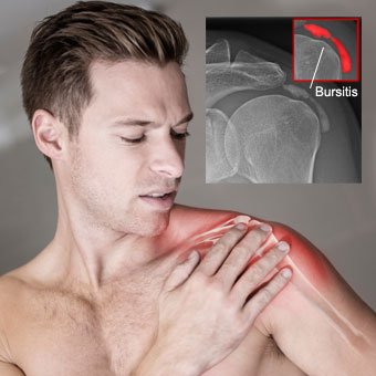 A man suffers shoulder pain due to bursitis.