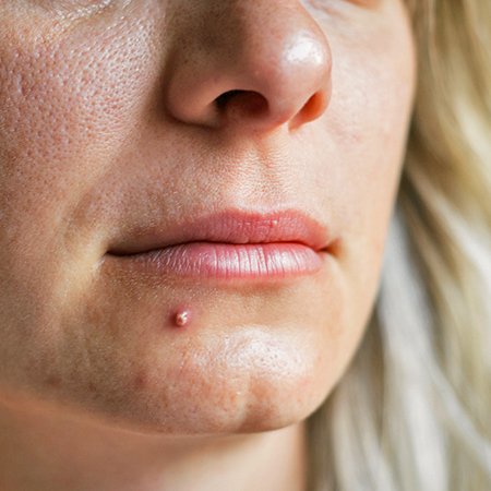 Picture of a pimple