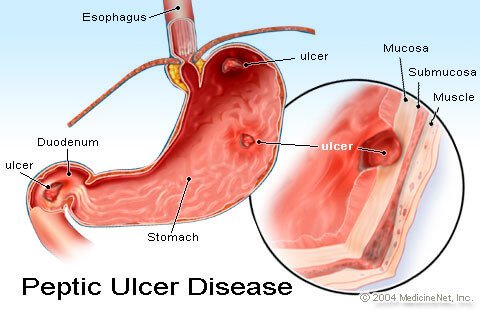 Illustration of a peptic or stomach ulcer.