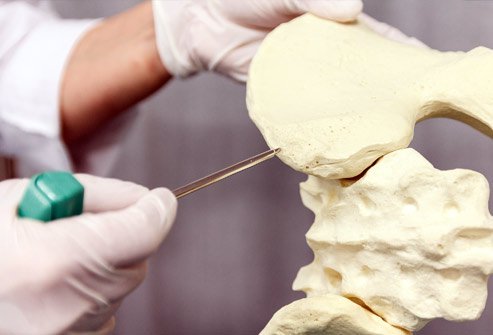 Doctors use special tools to extract bone marrow for bone marrow transplantation.