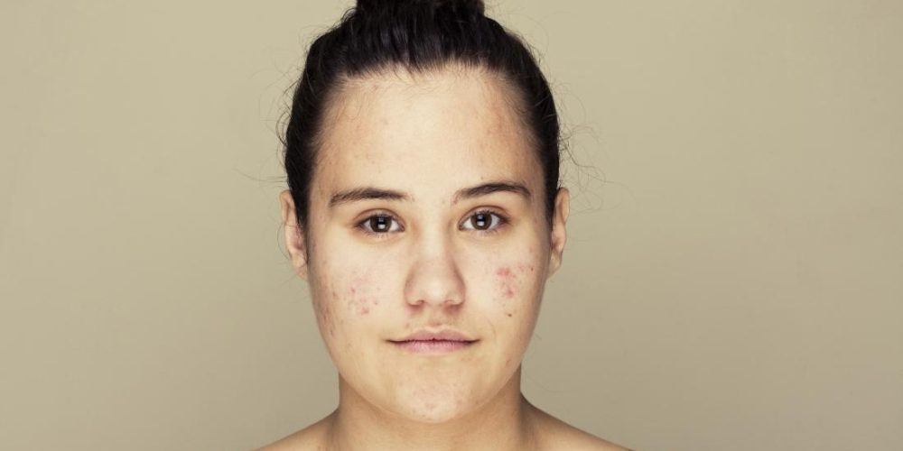 Acne: How common drug changes skin microbiome