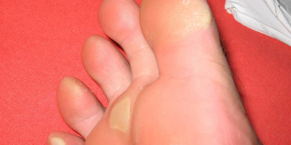 Causes of yellow feet