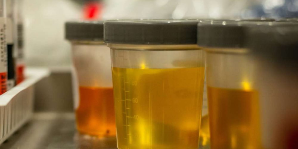 Everything you need to know about urinalysis