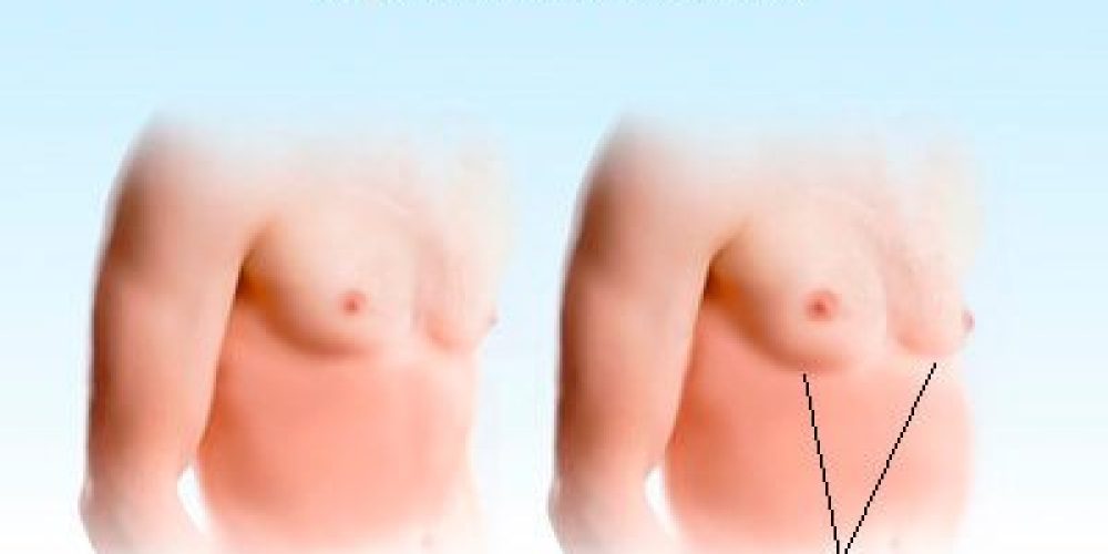 Gynecomastia (Enlarged Male Breasts Symptoms, Causes, and Treatments)