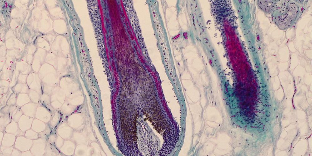 Hair follicles can be a site of origin for melanoma