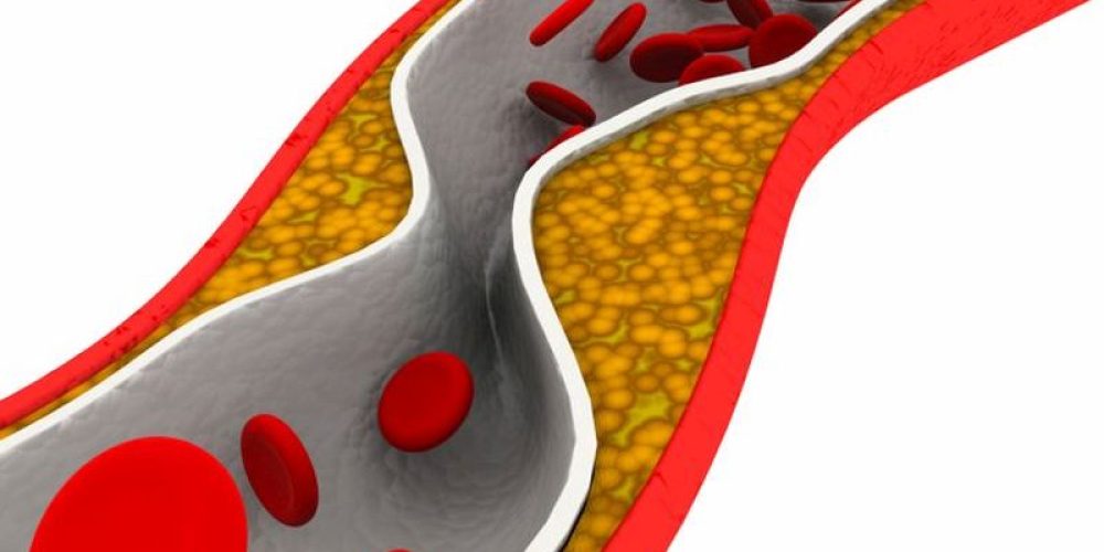 Heart Attack Treatment Could Cut &#8216;Bad&#8217; Cholesterol by Half Within Hours