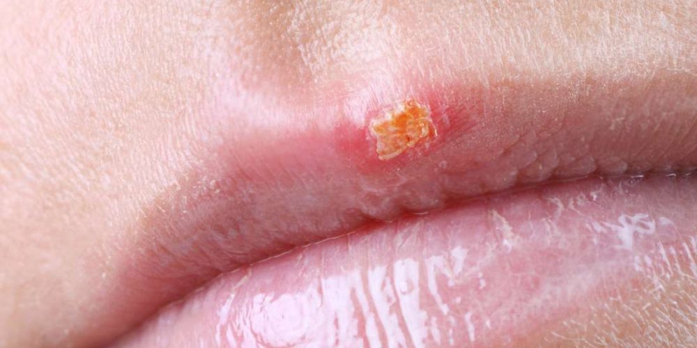 How long are cold sores contagious for?