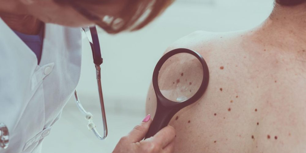 Skin cancer may predict future cancers
