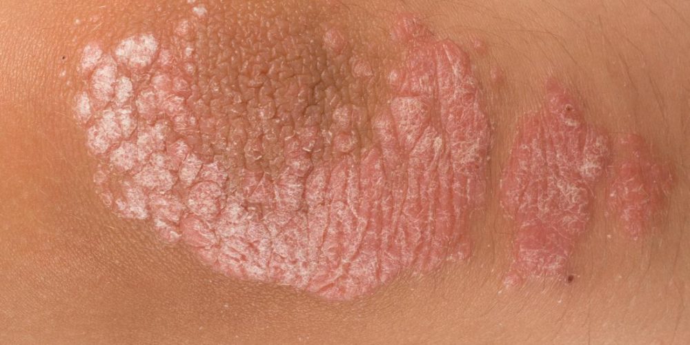 What are the signs and symptoms of psoriasis?