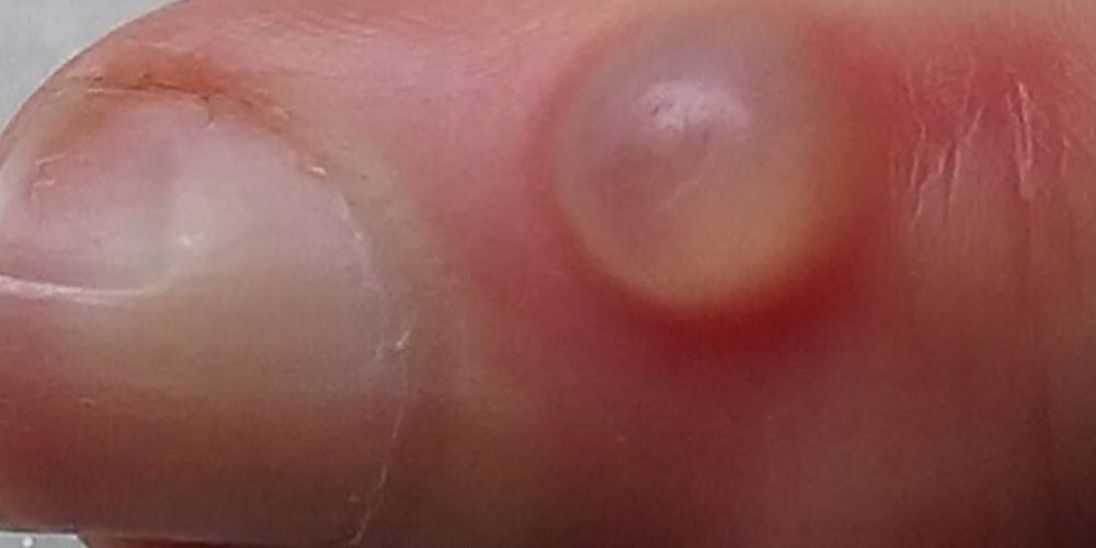 What to know about a pimple on the finger