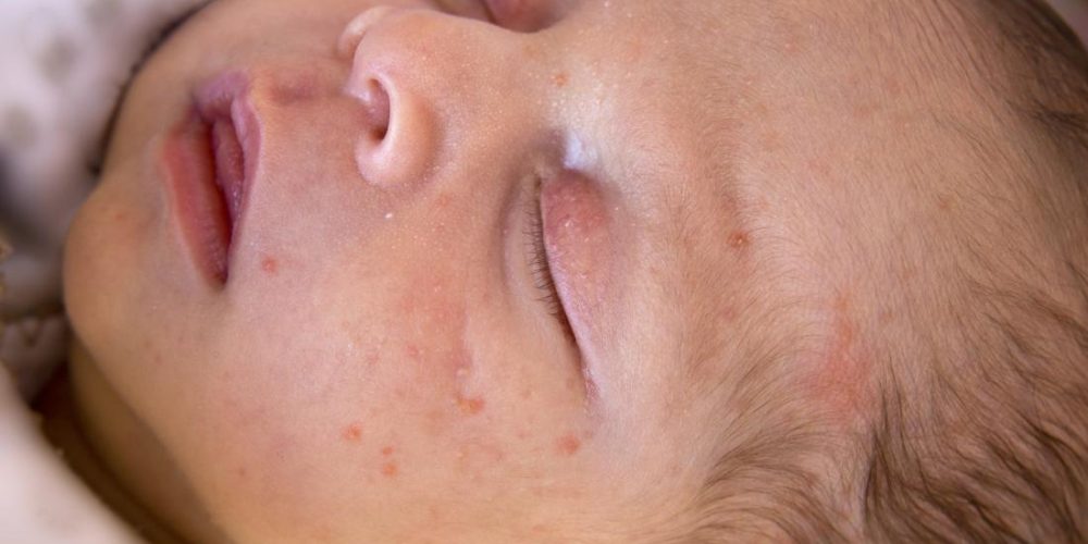What to know about baby acne