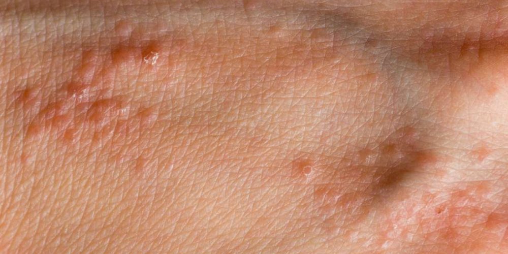 What to know about hand pimples