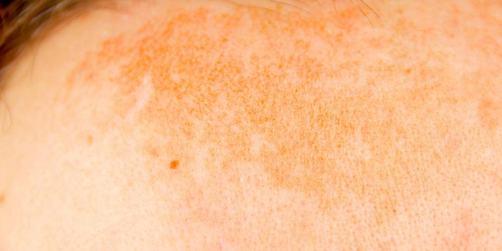 What to know about hyperpigmentation