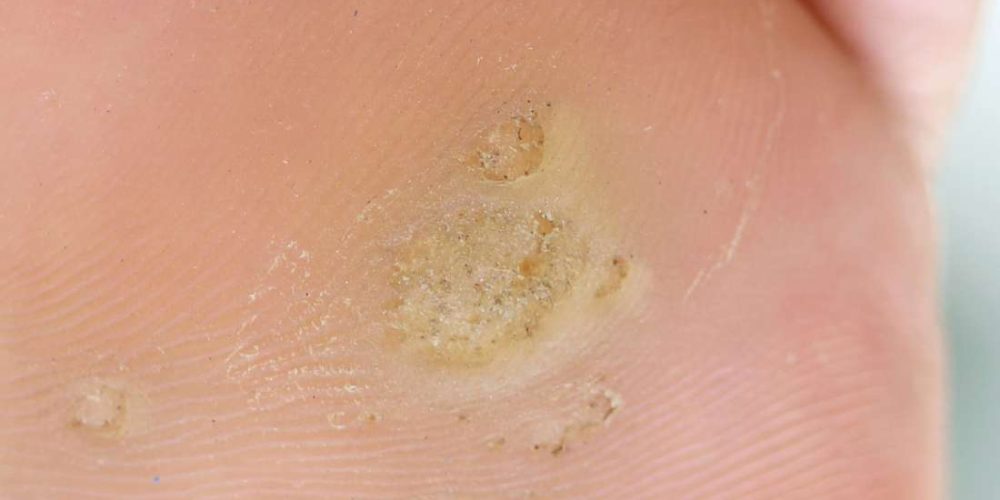 What to know about plantar callus