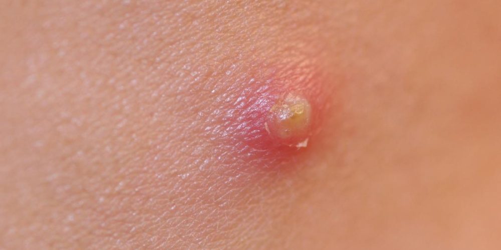 What to know about pustules