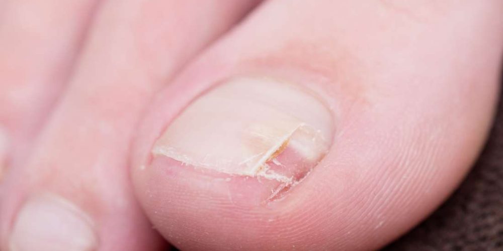 What to know about split nails