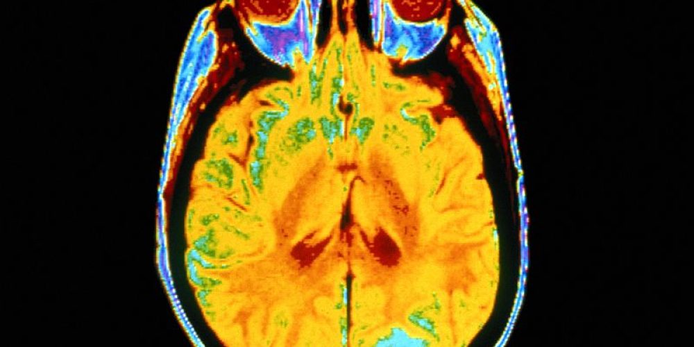Brain Scans Spot, Track Alzheimer&#8217;s