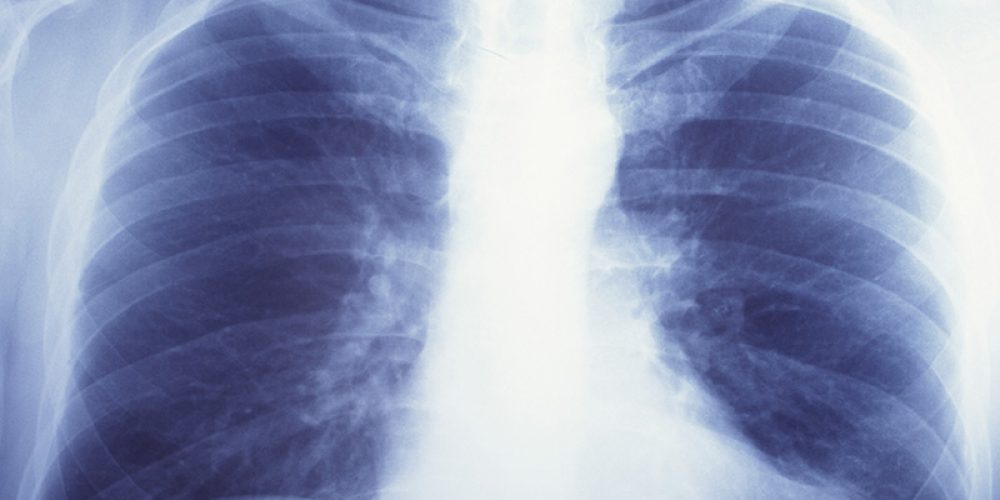 &#8216;Double-Edged Sword&#8217;: Lung Cancer Radiation Rx May Raise Heart Attack Risk