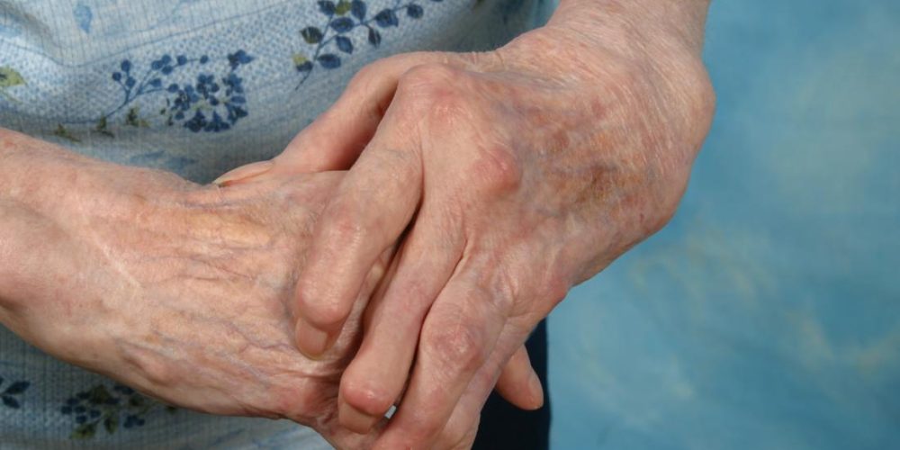 How do you manage arthritis in hands?