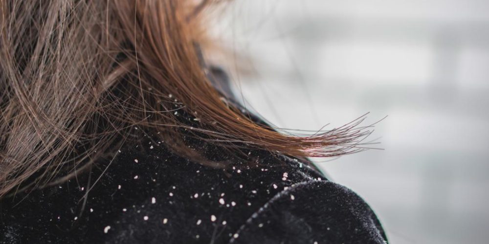 Is there a link between dandruff and hair loss?