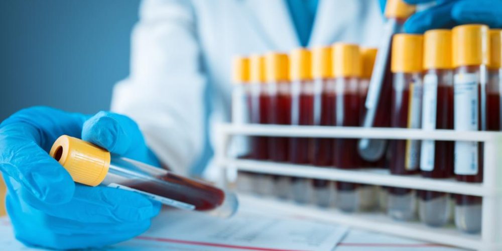 New blood test detects brain tumors with 87% accuracy