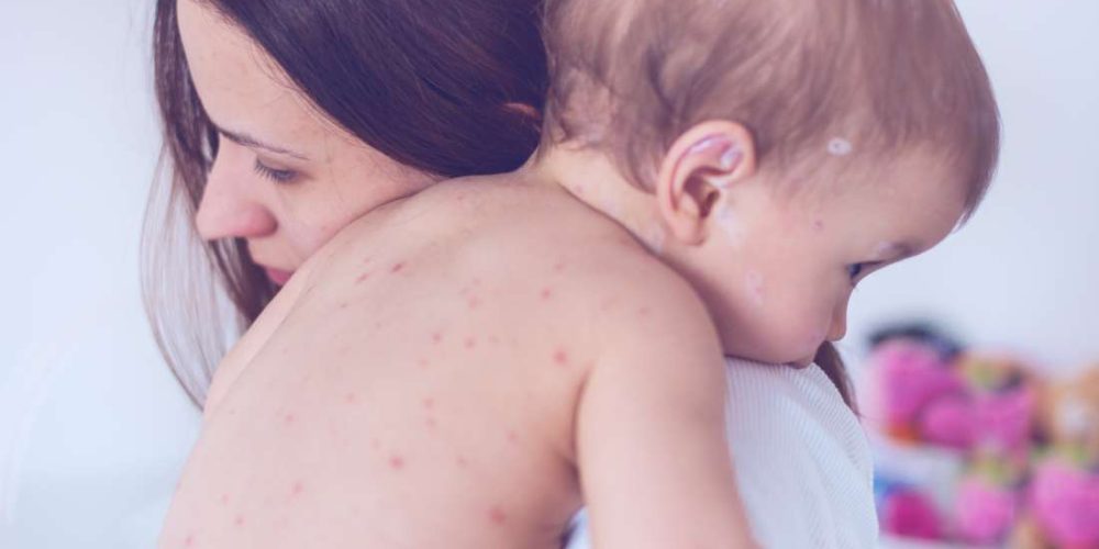 What to know about chickenpox in babies